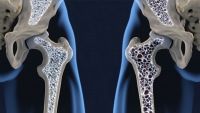 Rozhovor o osteoporóze s reumatologičkou MUDr. Soňou Tomkovou