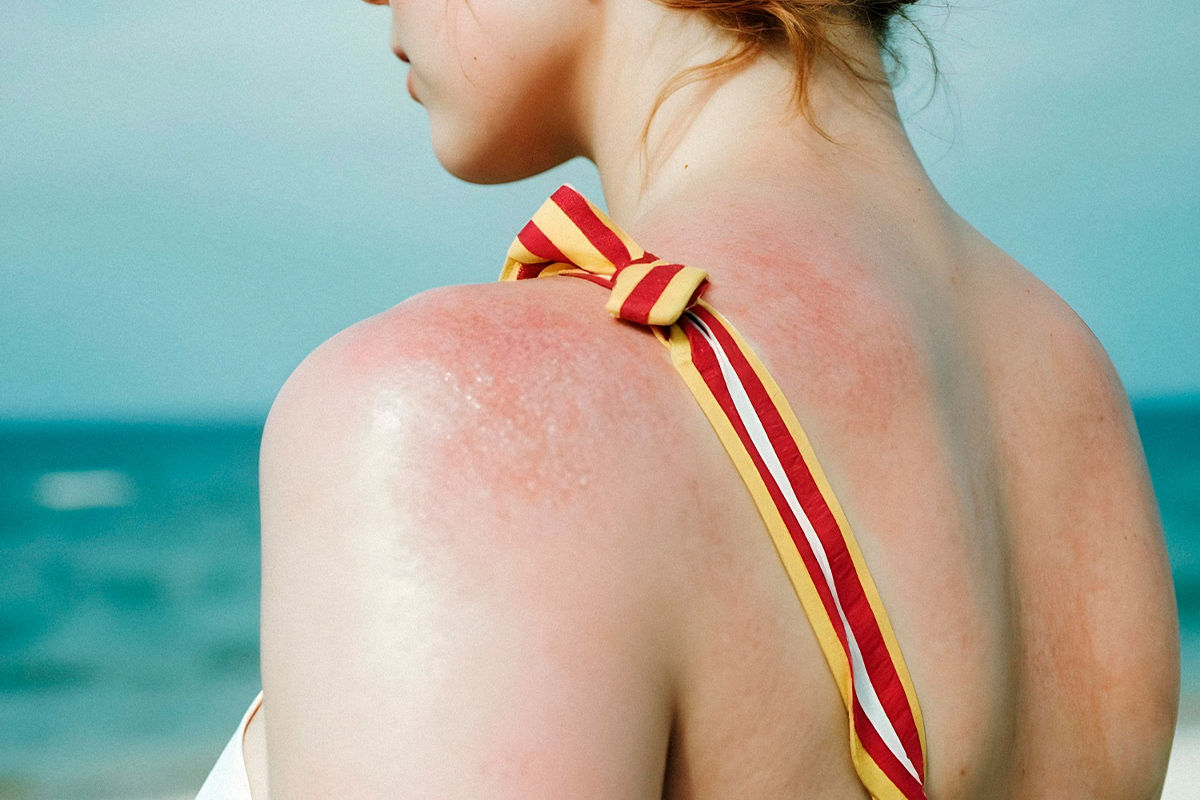 freepik_atopic_skin_summer