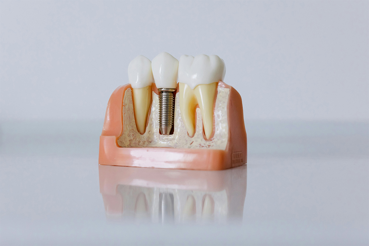 zubny_implantat