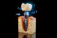 Zubný implantát, nedajte sa nachytať na podozrivo nízke ceny