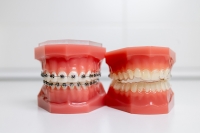 Krivé zuby: Spôsobujú vážne zdravotné problémy